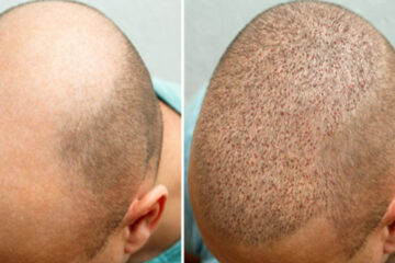 Recovering After a Hair Transplant What to Expect