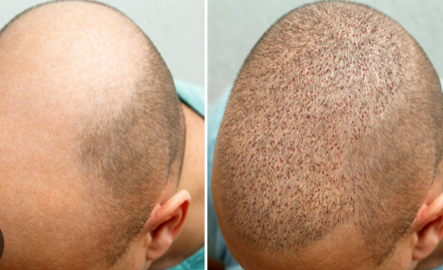 Recovering After a Hair Transplant What to Expect