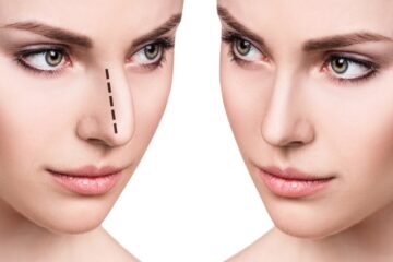 The Realities of Rhinoplasty Expectations vs. Outcomes